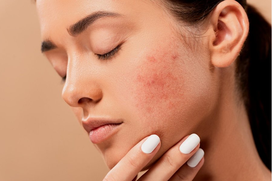 say goodbye to adult acne
