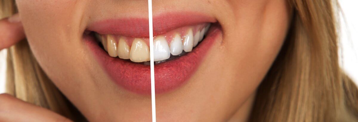 supersmile teeth whitening toothpaste